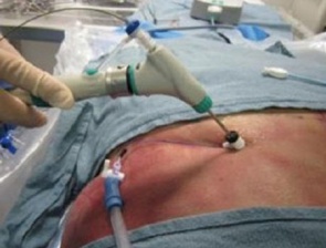 جراحی دیسک با لیزر در اسلامشهر